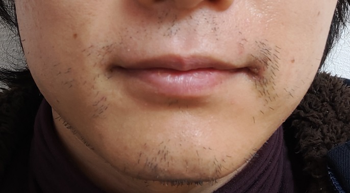 レポート Dr コバで髭脱毛後の変化 2回目施術後 小茂根の暮らし