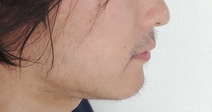 レポート Dr コバで髭脱毛後の変化 3回目施術後 小茂根の暮らし